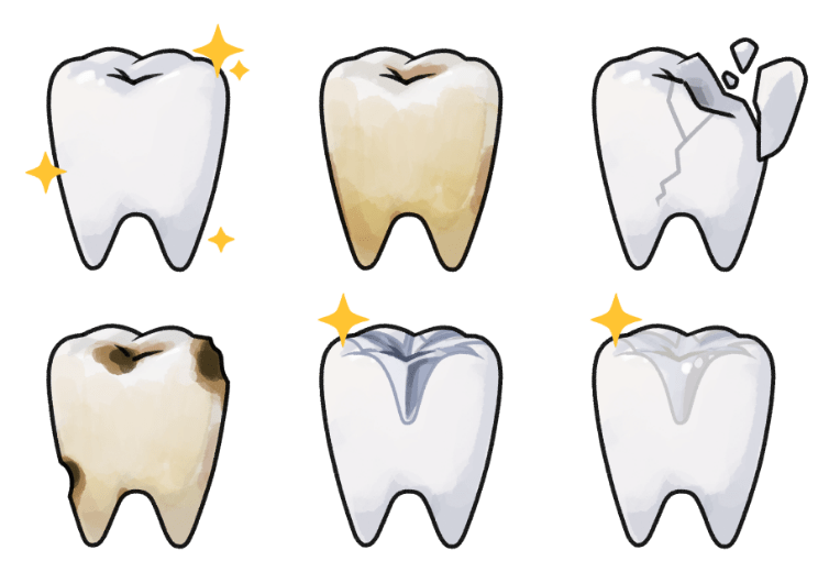 詰め物や被せ物が必要な歯