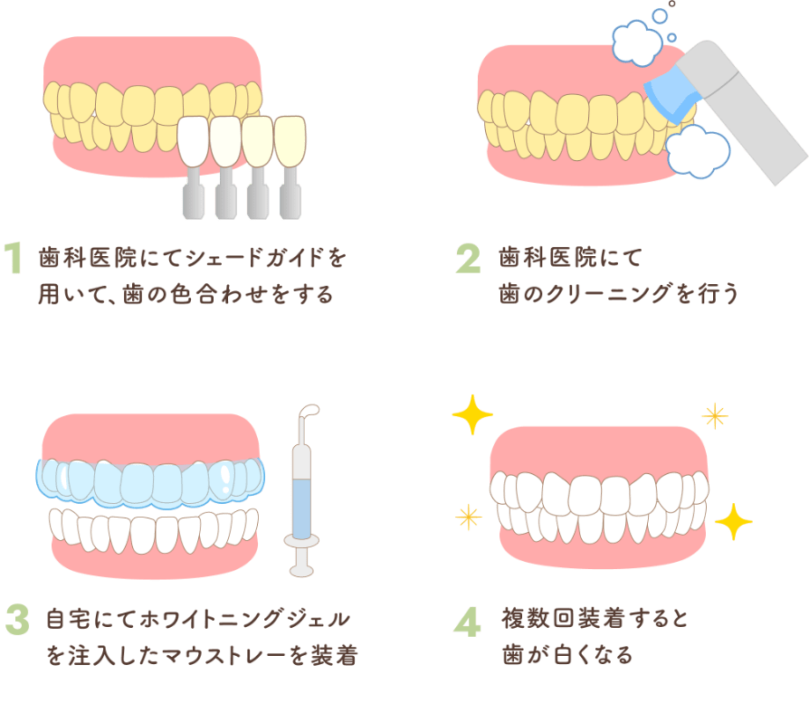 ホームホワイトニングの手順