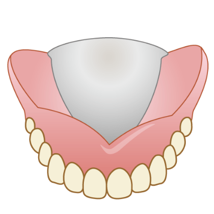 金属床義歯