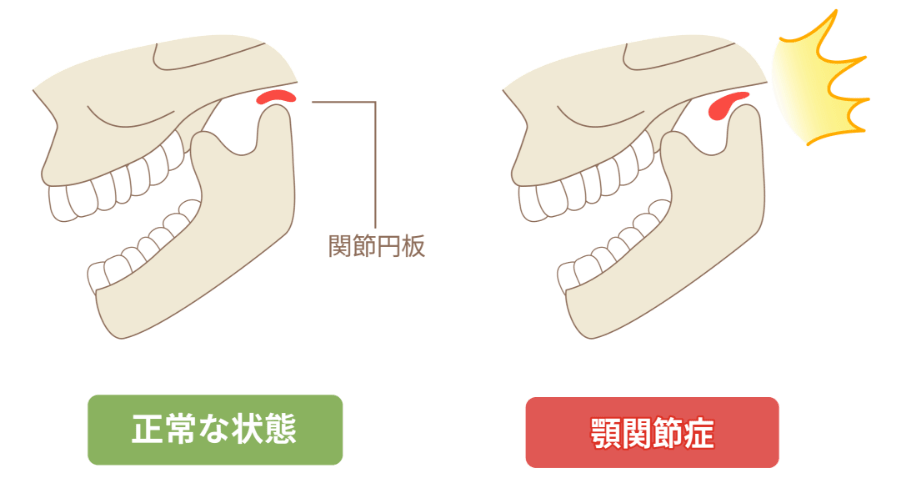 正常な状態と顎関節症の違い