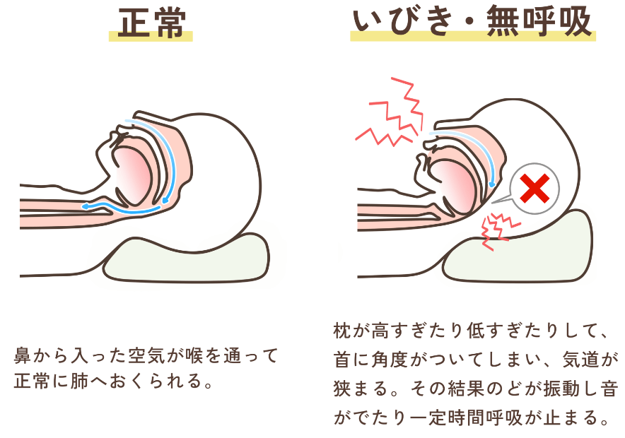 正常な時といびきをかいている時の比較